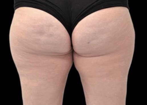 EMTONE GLUTES After
