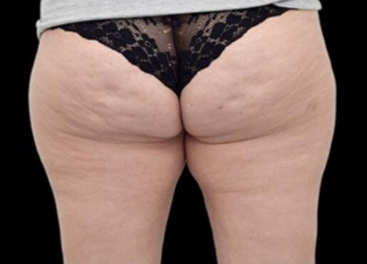EMTONE GLUTES Before