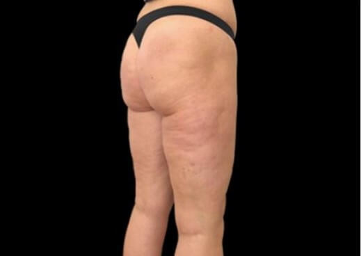 EMTONE THIGHS After
