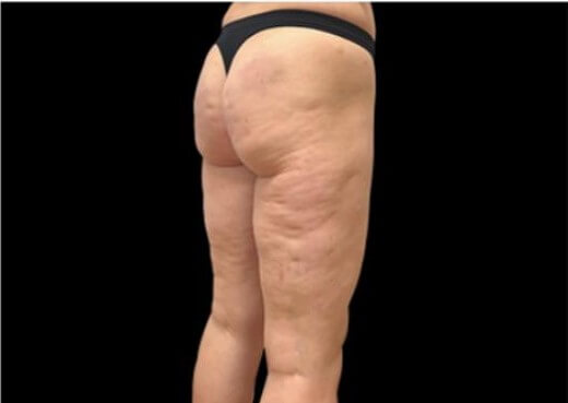 EMTONE THIGHS Before