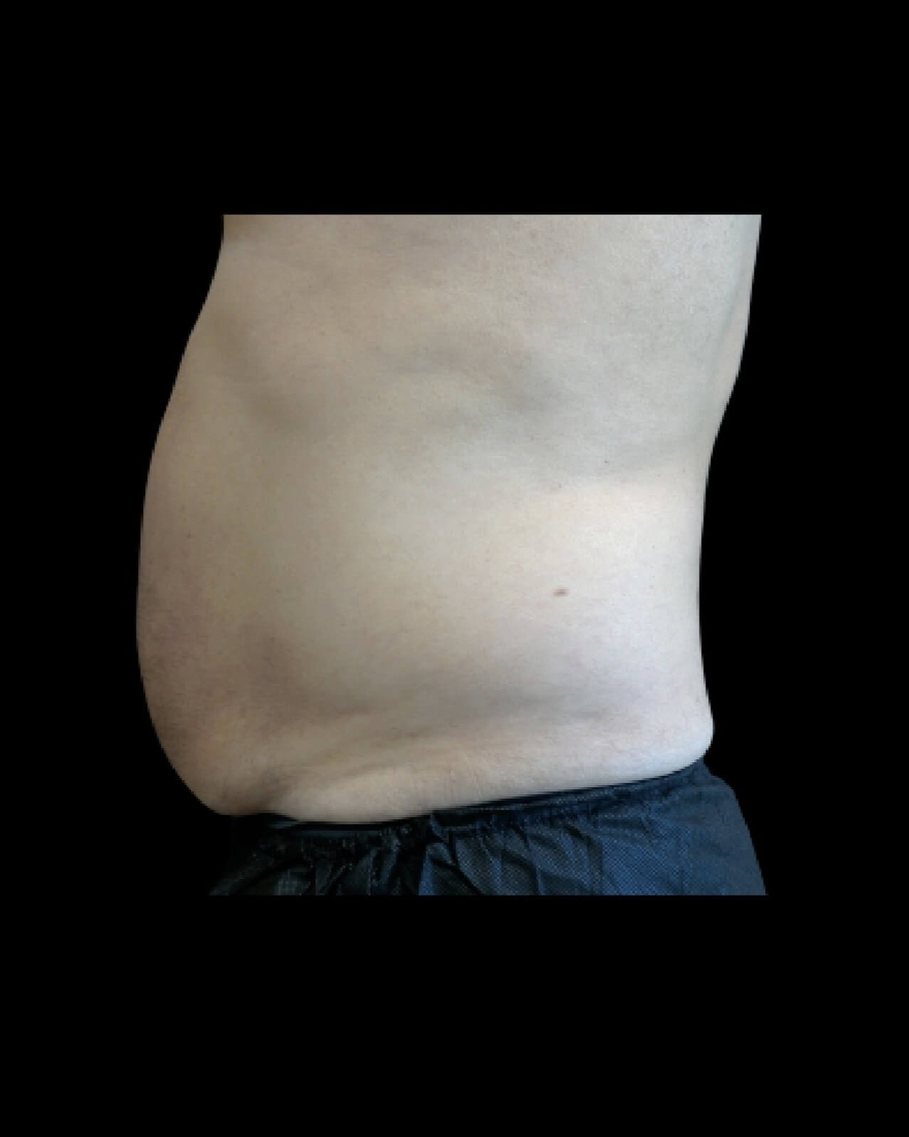 Emsculpt Neo Abdomen 2 after