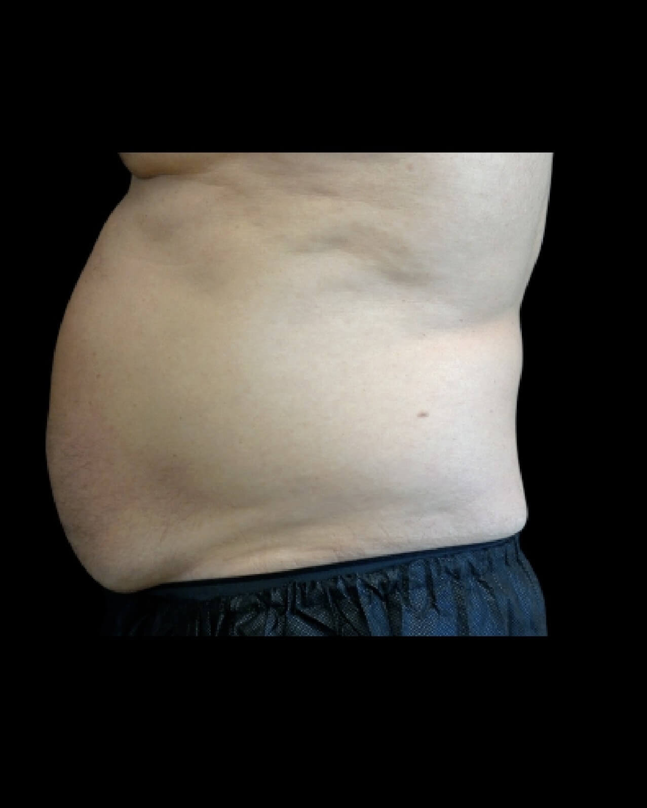 Emsculpt Neo Abdomen 2 before
