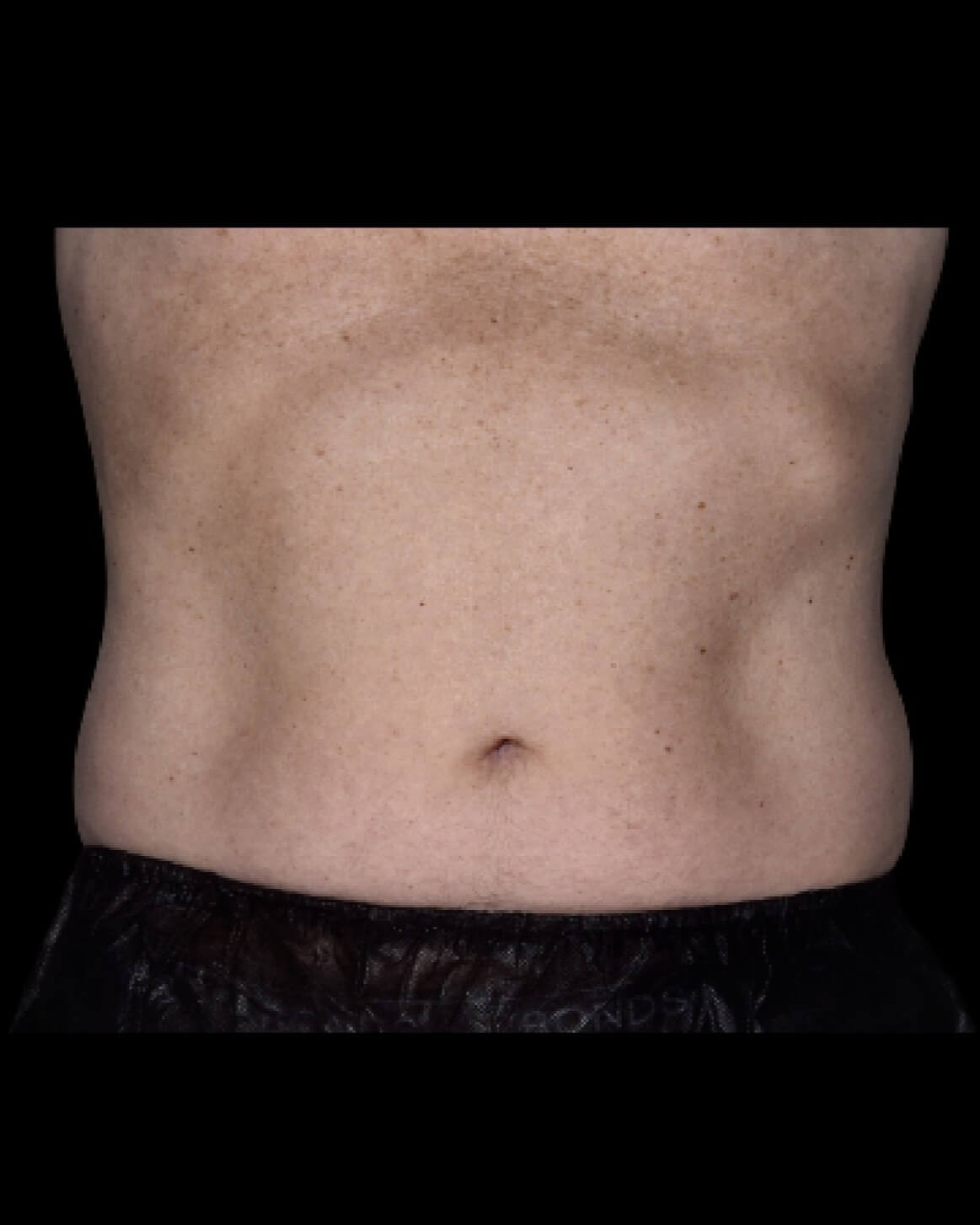 Emsculpt Neo Abdomen 3 after