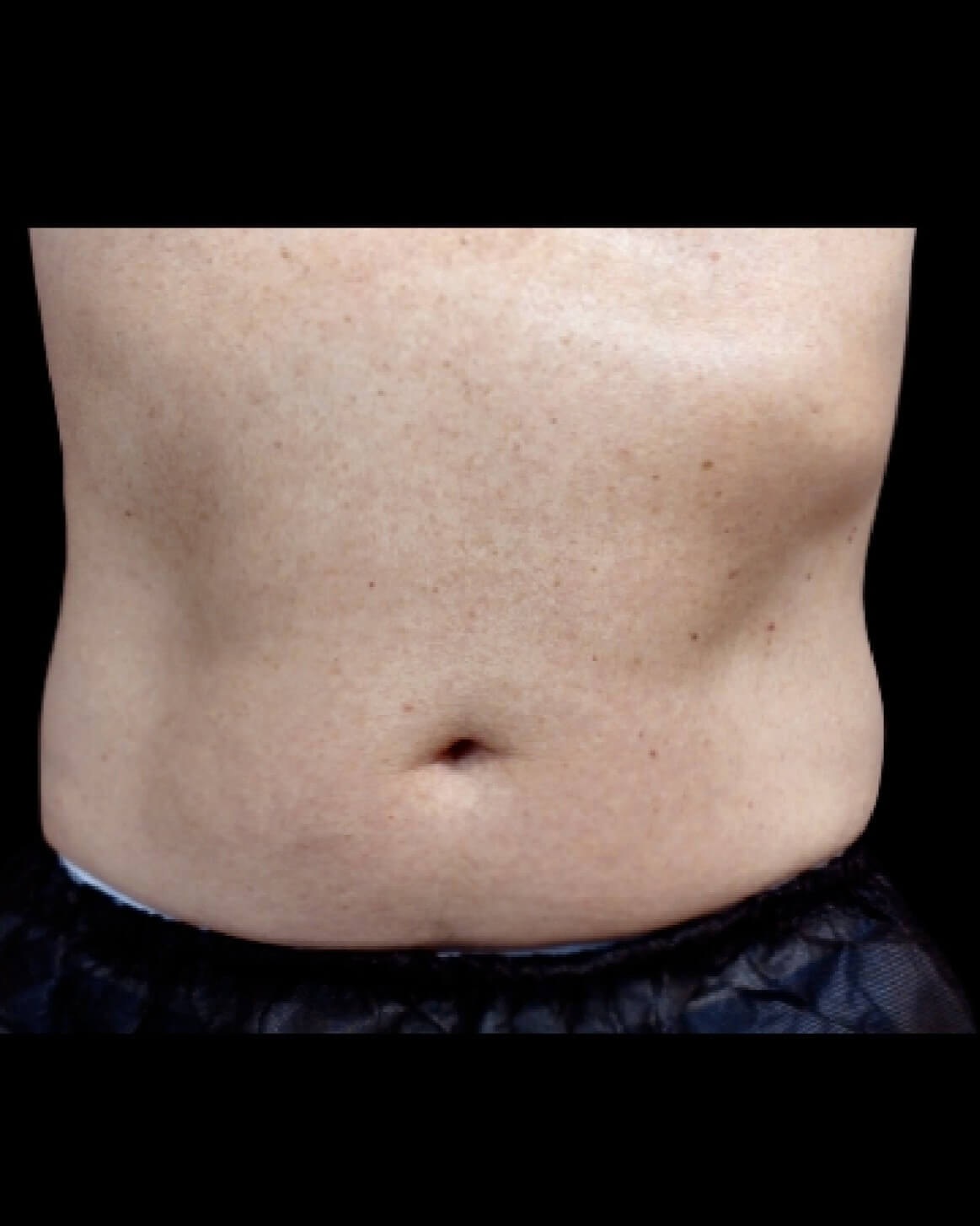 Emsculpt Neo Abdomen 3 before