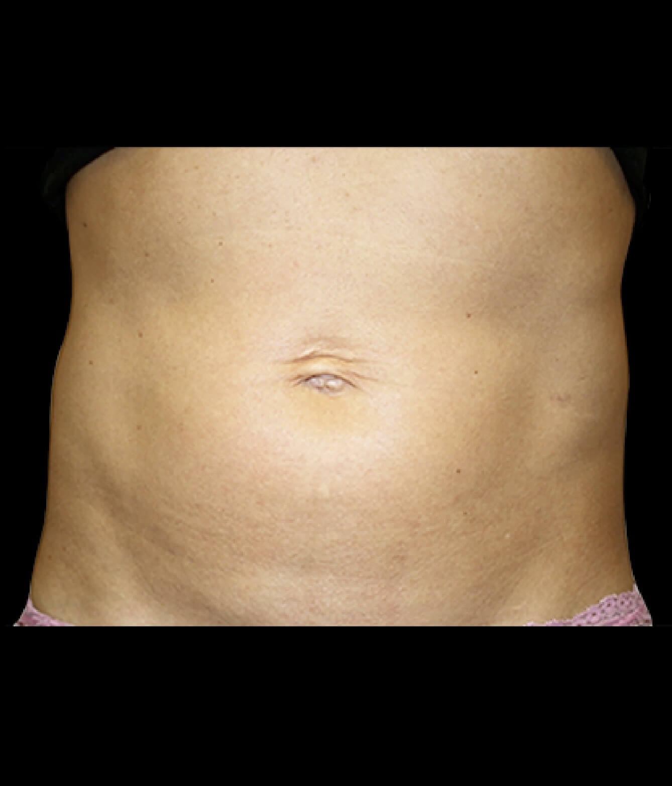 Emsculpt Neo Abdomen 4 after