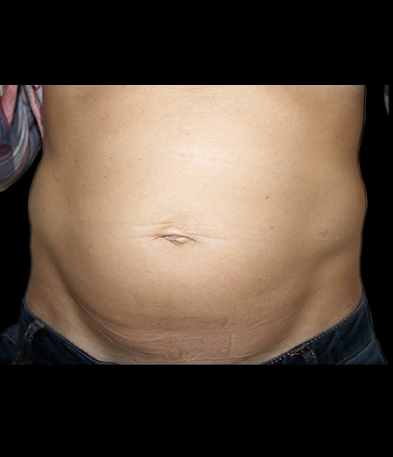 Emsculpt Neo Abdomen 4 before