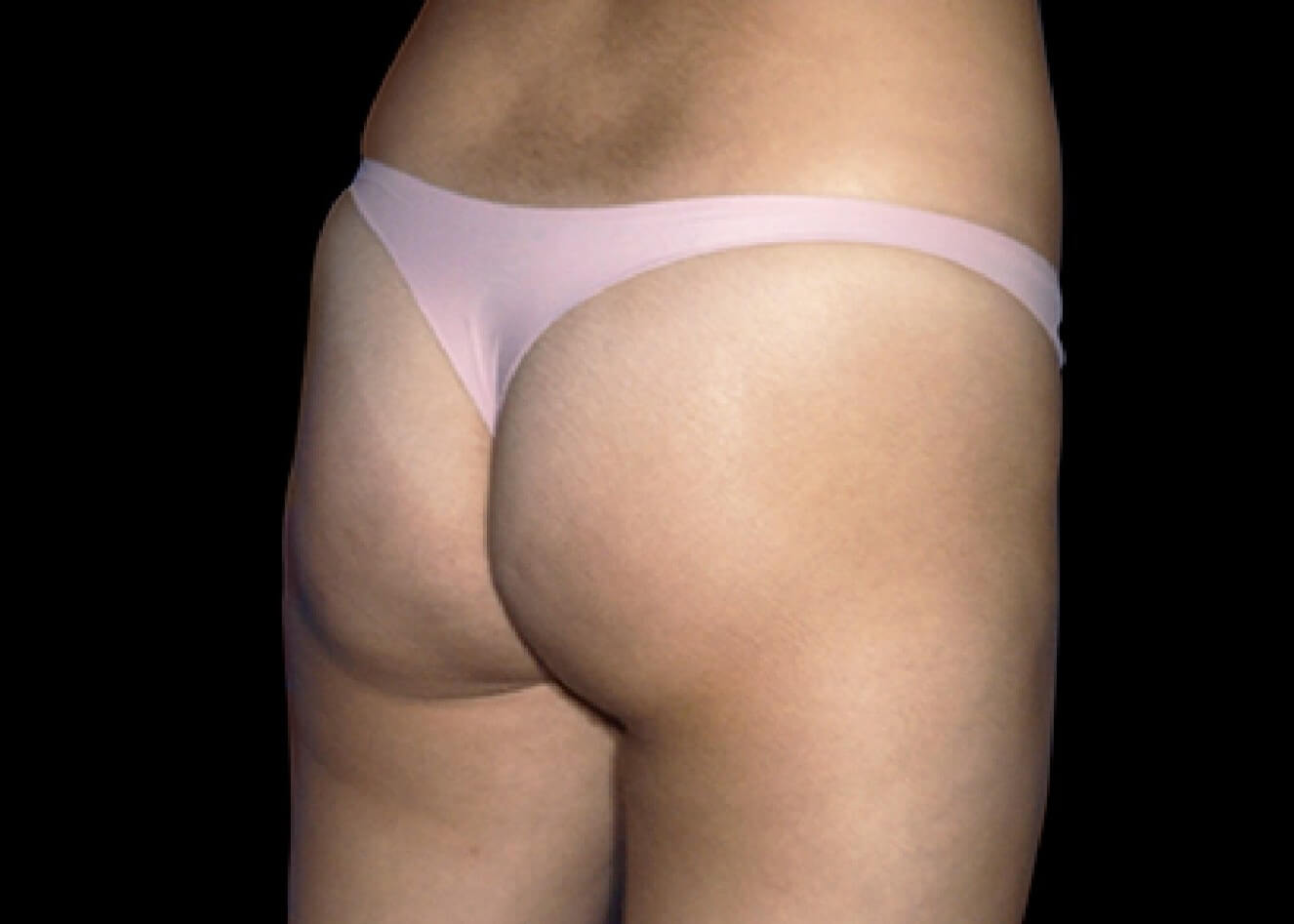 Emsculpt Neo Glutes after