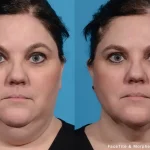 Facetite