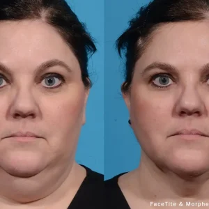 Facetite