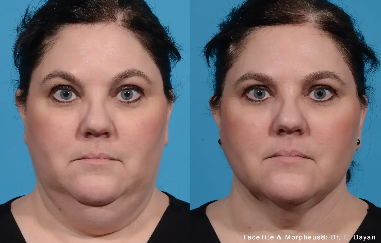 Get the best FaceTite London | Non-Surgical Treatment