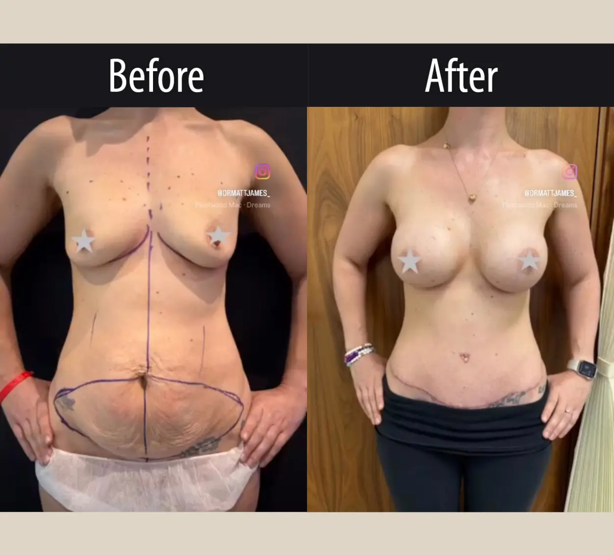 Surgery Client A Before After