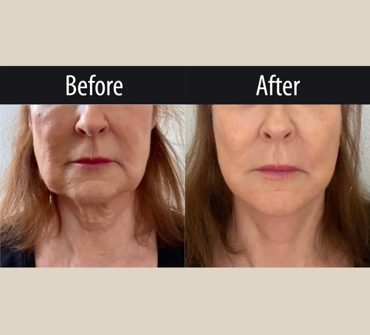 Surgery Client I Before After