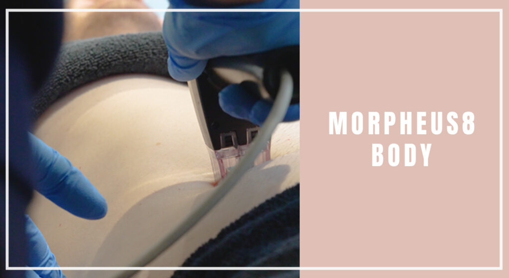 Morpheus8-Body--Tightening-and-Remodelling-Skin